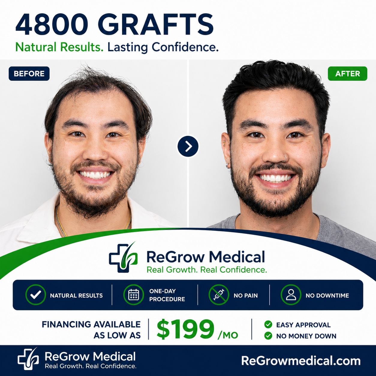 ReGrow Medical patient before and after 4,800 graft FUE hair transplant — full hair restoration